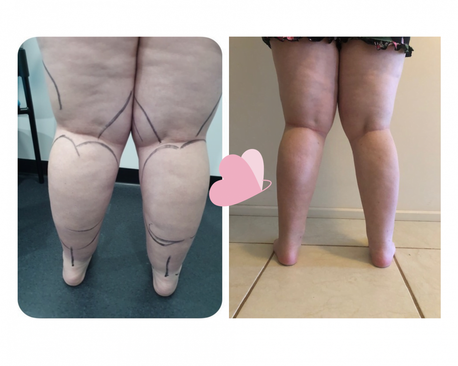 Lipoedema Surgery Case 6 Lipoedema Surgical Solution 