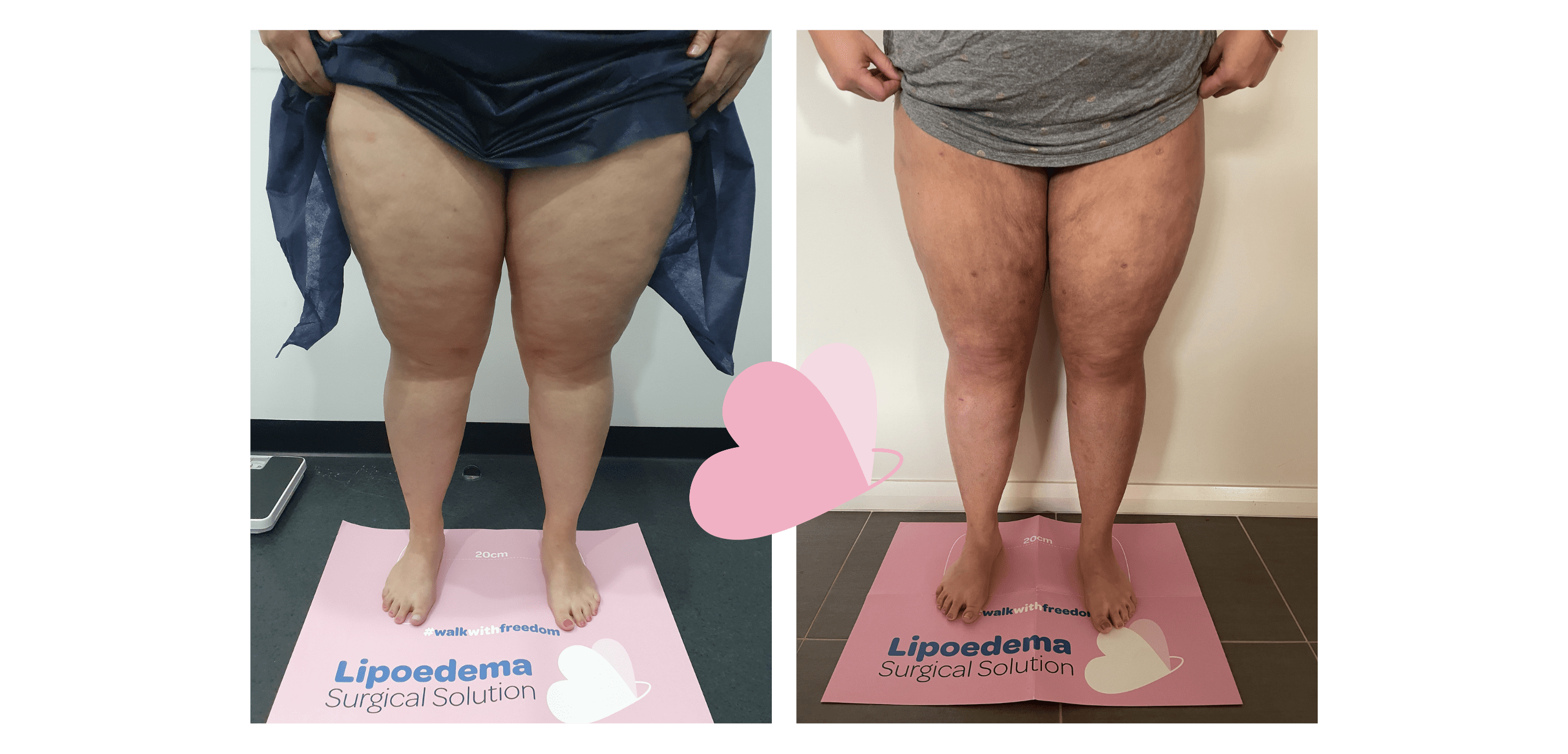 Learn About Lipedema Nutrition Before Surgery
