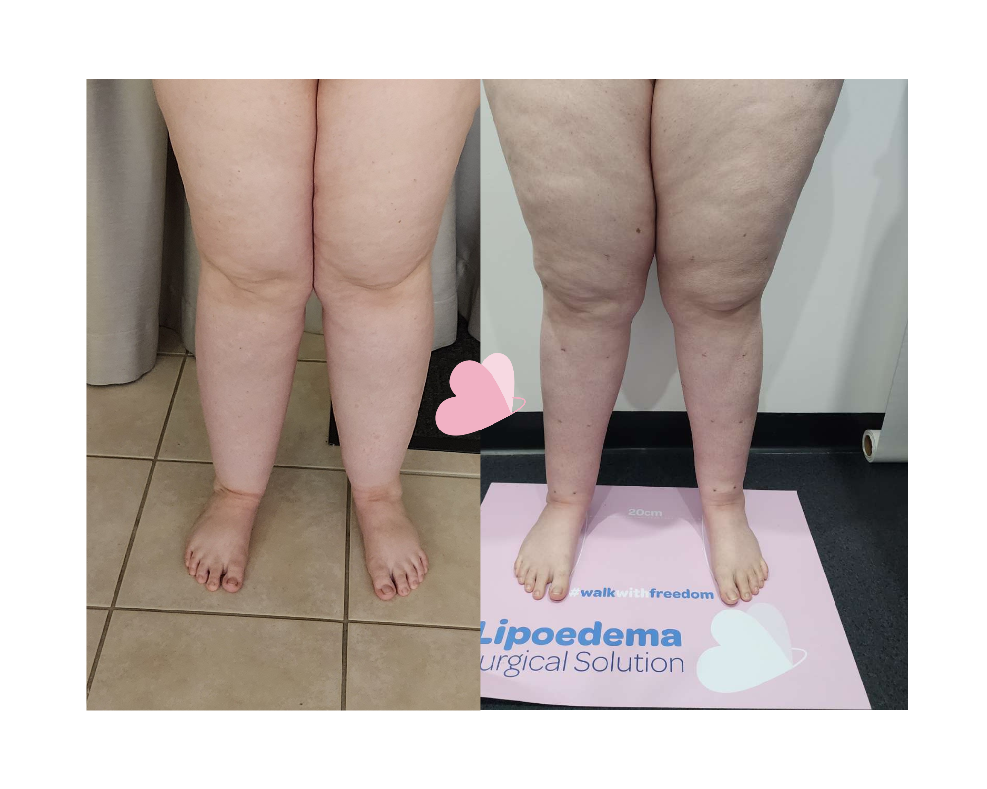 lipedema - Look Younger Clinic