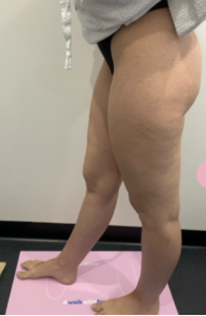 Stage 1 lipoedema image 2