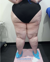 Stage 3 lipoedema image 3