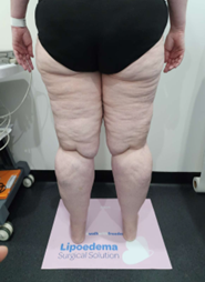 Stage 4 lipoedema image 3 - Lipo, Lumphoedema with fluid retention
