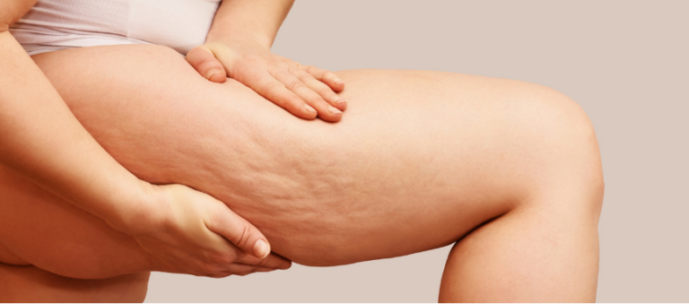 Image showing cellulite on leg