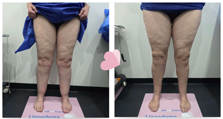 What is lipoedema