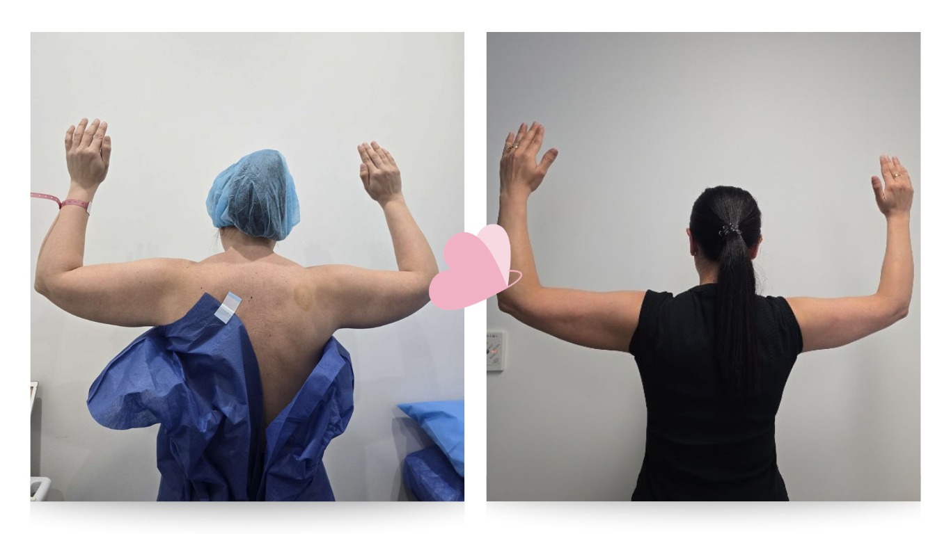 Pre surgery (L) Post surgery (R)