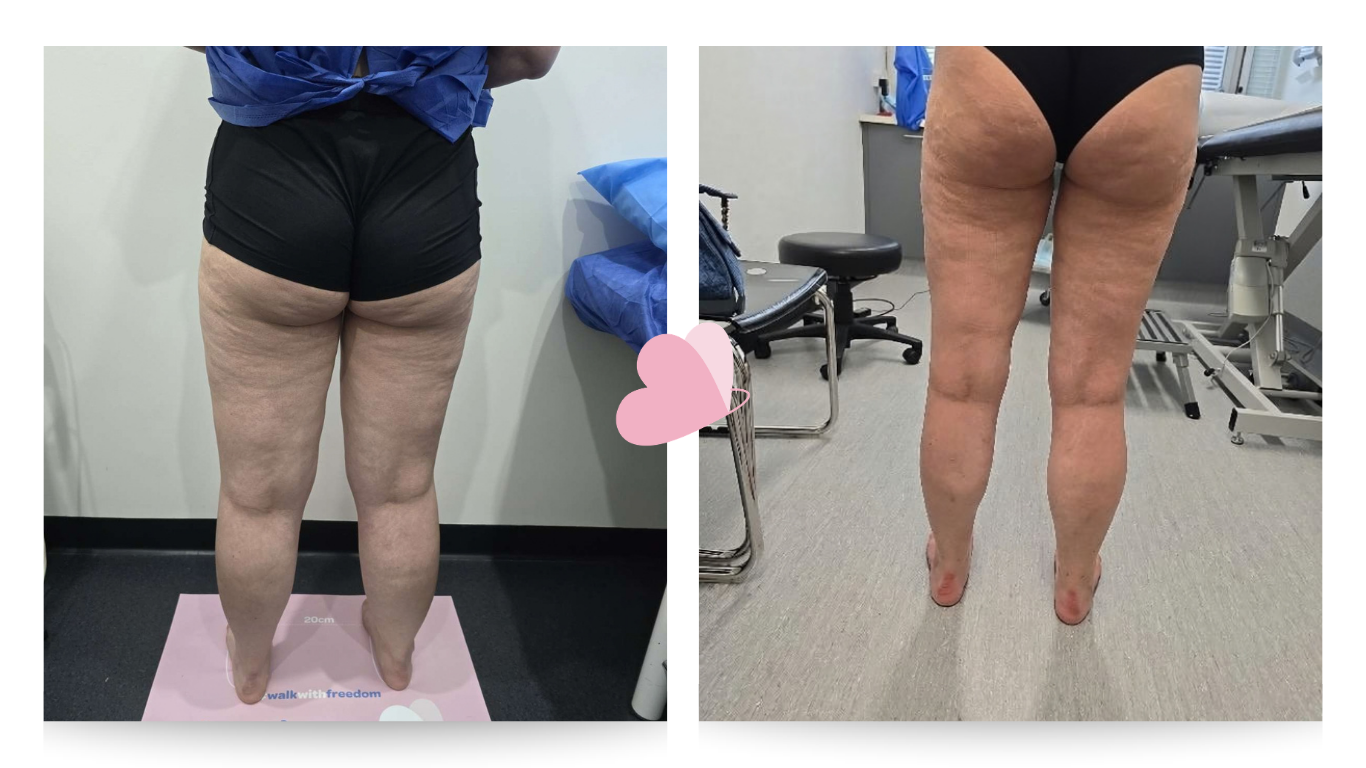 Pre surgery (L) Post surgery (R)