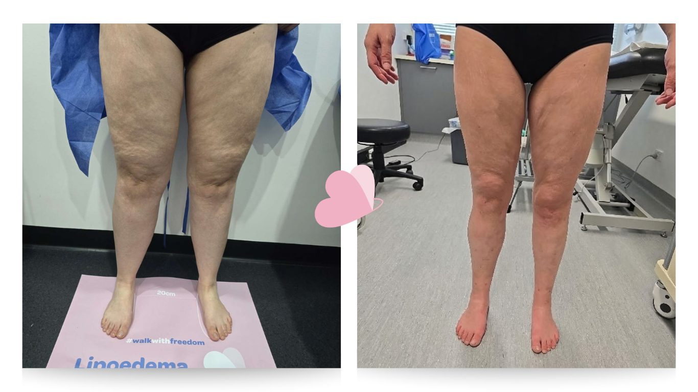 Pre surgery (L) Post surgery (R)