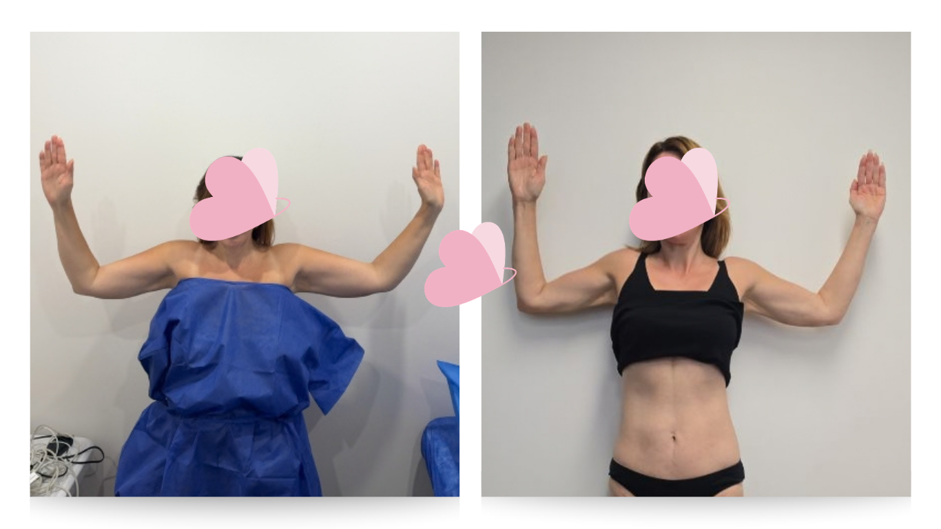 Pre surgery (L) Post surgery (R)