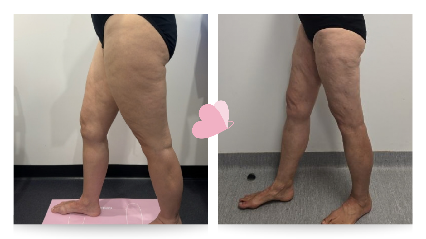 Pre surgery (L) Post surgery (R)