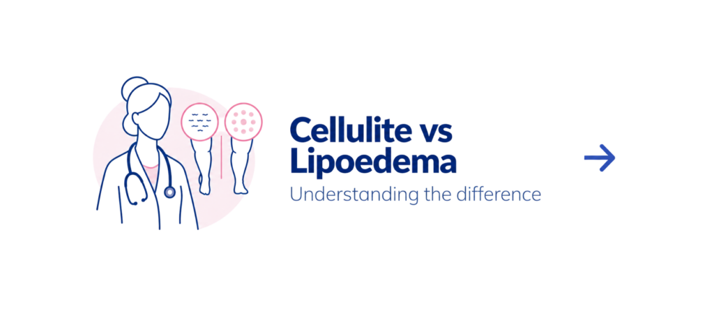 cellulite vs lipoedema differences